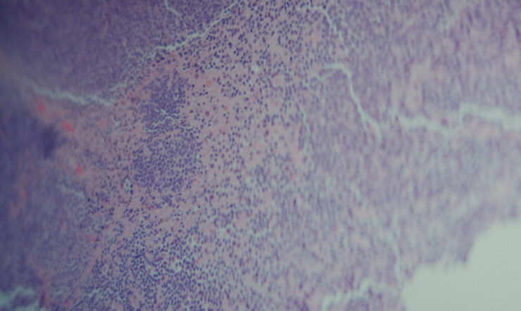 BrainChild: en datadriven kamp mot barncancer